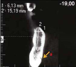 Lingual foramenin boyutu ve kemik kret sınırlarına olan mesafesi vertikal olarak ölçülür.