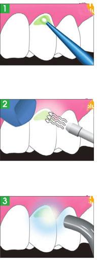 Direk ve indirek restorasyonlarda, diş preperasyonundan sonra diş hassasiyetinin azaltılması ve/veya