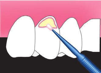 BOND FORCE KALEM Diş Yüzeyine Tutunma Gücü mpa Mine Dentin BOND FORCE 32 28 Clearfil S3 Bond 28 23 Optibond All On