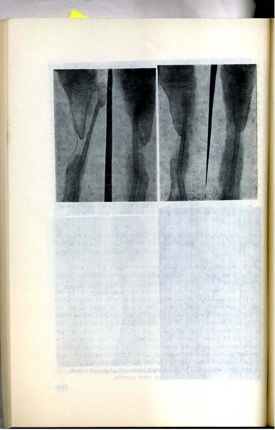 Resim: 10 - Vaka 2'de tibia diafi- Resim: 11 - Vaka 2'de tibula ile zindeki demik defekti. tibia arasında sinostoz ameliyatı yapıldıktan sonra.
