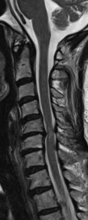 Spinal Kord Patolojisi Disk