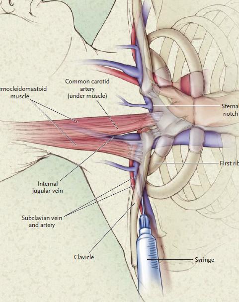 5 Sternokleidomastoid Kas Ana karotid arter (kasın altında) Sternal çentik Birinci kosta internal juguler ven Subklavian ven ve arter Klavikula enjektör Resim 1.