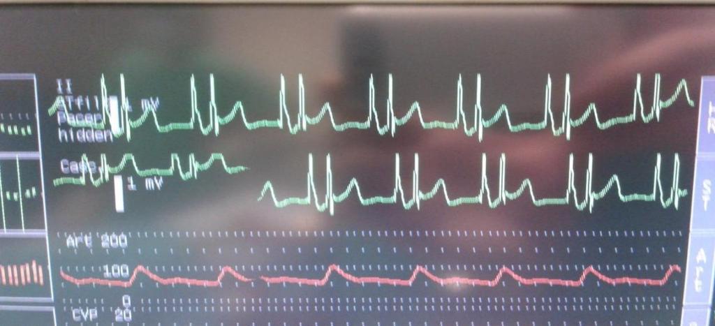 15 Resim 2. İntrakardiyak EKG elektrodu bağlantı aparatı V 1 (kırmızı)elektroda bağlanır kılavuz tele bağlanan ara kablo aracılığı ile sinyal alınır. Resim 3. İntrakardiyak EKG dalgaları Tablo1.