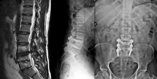 Şekil-1. a. Faset eklem ve disk patolojilerine bağlı gelişen dejeneratif spinal kanal stenozu. b.aynı vakanın revizyon cerrahisi sonrası görüntüleri.