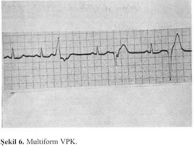 ÇOCUKLUK ÇAĞINDA SİK GÖRÜLÜN RİTM PROBLEMLERİ Funda ÖZTUNÇ ile birlikte olabilirler. Normal kalbi olan çocuklarda tek, uniform VPK'ları tedaviye gerek yoktur.