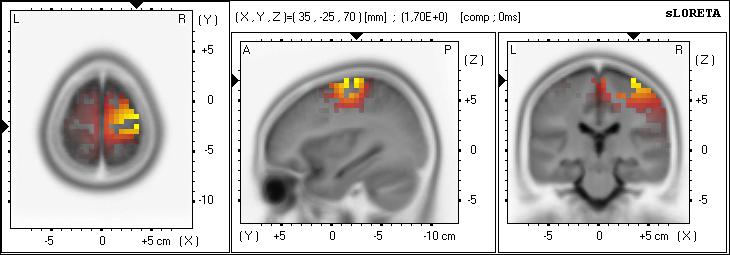 sloreta localization: Brodmann area 6(Precentral Gyrus, Frontal Lobe)[Brodmann area 4(Precentral Gyrus, Frontal Lobe)] Brodmann area 6: Is located in the frontal cortex and includes the premotor area