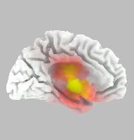 Best Match at 17mm Brodmann area 8 Superior Frontal Gyrus Frontal Lobe Brodmann area 25 Anterior Cingulate