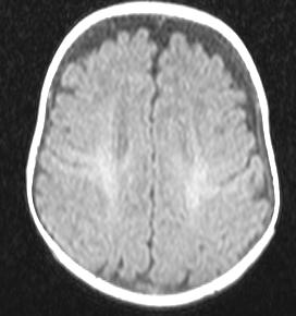 Myelinizasyonu Tamamlamamış Beyin MR T2A