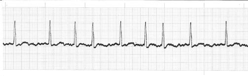 KLİNİK TIP BİLİMLERİ TESTİ AÇIKLAMALI CEVAPLAR 1. Mitral darlığı nedeniyle takip edilmekte olan bir hastanın elektrokardiyogramı aşağıda yer almaktadır. EKG de izlenen ritm aşağıdakilerden hangisidir?