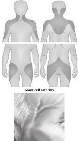 A) Pilositik astrositom B) Atipik Teratoid Rabdoid tümör C) Ependimom D) Koroid pleksus papillomu E) Pleomorfik ksantoastrositom 33 C Epandim ve Koroid Pleksus Tümörleri Epandimoma, ventriküllerin ve