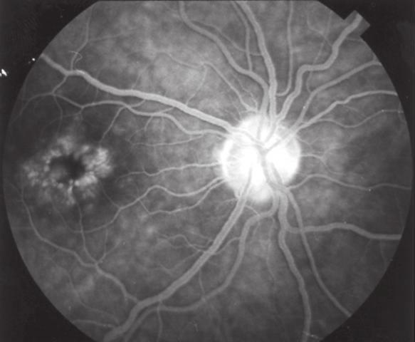 Ret-Vit 2007;15:71-75 73 Resim 1: FA nın geç evresinde taç yaprağı şeklinde kistoid makula ödemi. Resim 2: FA nın geç evresinde optik sinir başında hiperflöresans ve afakik kistoid makula ödemi.