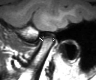 Gökalp Magnetic Resonance Imaging Unilateral left- sagittal TMJ MRIs were taken to visualize the changes in condyle position and the glenoid fossa growth direction.