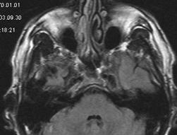 fiekil 2. 1 Hafta sonraki kranial MR. Ponsta hiperintens ve ekspanse görülen lezyonun küçülmeye bafllad, cerebellar folyumlar n belirginleflti i görülmektedir. ensefalit tan s ndan uzaklaflt rm flt r.