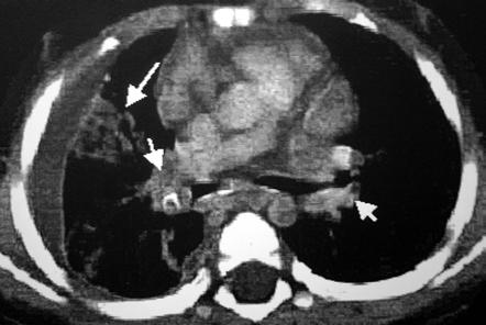 Çocuklarda Akciğer Tüberkülozu: BT Parankim Bulguları / Childhood Pulmonary Tuberculosis: Parenchymal CT Findings 25 Resim 3.