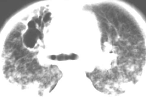 Bilateral yaygın 1-2 mm çaplarında yer yer birleşme eğilimi gösteren çok sayıda nodül izleniyor. Resim 6. Bilateral buzlu cam görünümleri (oklar) mevcut.