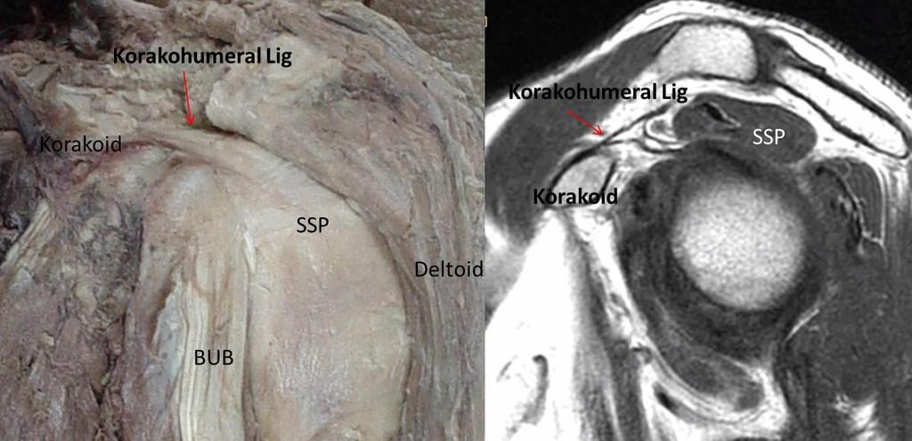 yırtıklarının rotator kresenti ilgilendirenlere göre daha fazla biyomekanik sorun yaşatabileceği düşünülmektedir. Supraspinatus insersiyon ayak-izi bisipital sulkustan çıplak bölgeye kadar uzanır.