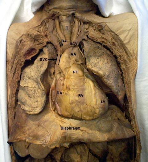 Disseke edilmiş kadavra, göğüs duvarı çıkarılmış ve mediastinum disseke edilmiştir.