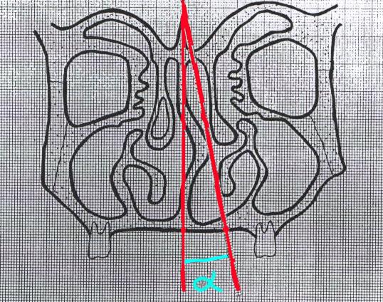 Mladina ve Subaric (2003) yapmış oldukları çalışmada tip 6 septal deformite bulunan tüm çocukların anne ve babalarında da septal defekt bulunduğunu bildirilmiştir ve tip 6 nın herediter olduğu ileri