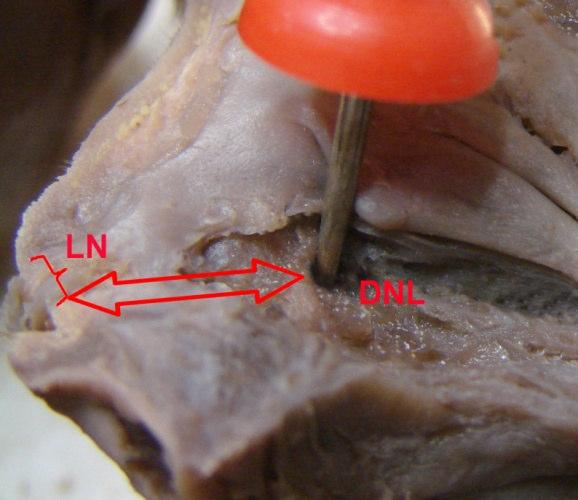 Limen nasi ve ostium ductus nasolacrimalis arası mesafe (LN-DNL): Limen