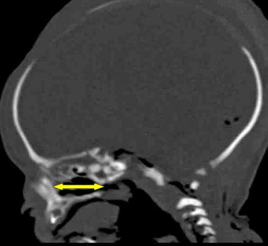 Reformat sagittal görüntülerde sağ ve sol olmak üzere CNI, CNM ve CNS uzunluk ölçümleri yapıldı (Şekil 2.17, 2.18, 2.19). Aksiyal ve koronal reformat görüntülerde SND değerlendirildi.