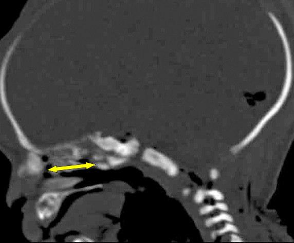 Ayrıca aksiyal görüntülerden septumun izlendiği orta hat seviyesinde anterior, media ve posterior seviyede nazal kavite hava boşluklarının aralık ölçümleri de yapıldı (Şekil 2.20, 2.21, 2.22, 2.23).