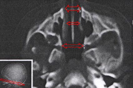 Şekil 2.23. Ön, orta ve arka septum bölgesinde nazal kavite hava boşluklarının genişliği. Choanae çapları: Choanae nın sagittal çapta ölçümü (Şekil 2.24) yapıldı.