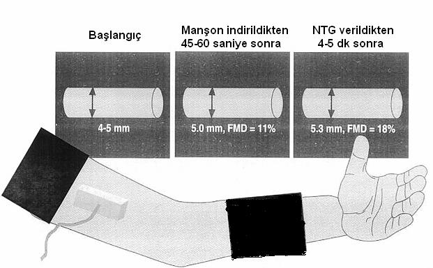 2,5 mm den küçük olursa ölçüm zorlaşır, 5 mm den büyük olursa da vazodilatasyonu tespit etmek zorlaşır. Şekil 2.7. Sfigmomanometrinin ve transducerin yerleştirilmesini gösteren şematik çizim.