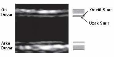 Şekil 2.8: Ön duvarda öncül ve uzak sınırın ultrasonografik görünümü (John Wikstrand, Clin Physiol Funct Imaging (2007) 27, pp341 345 ) Şekil 2.