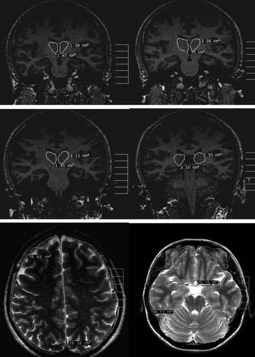 246 Nöropsikiyatri Arflivi 2011; 48: 243-8 dışında 1 olguda absans nöbetleri görülmediği halde absans status epileptikus atakları olmaktadır. Miyokloni nöbeti olan; 19 olgu mevcuttur.