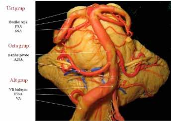 VA anevrizmasını veya PİSA proksimal anevrizmasını ortaya çıkarır. VB bileşkeye kadar VA diseksiyonu tüm arterin kontrolüne olanak verir. VA seyri boyunca 9., 10. ve 11. kranial sinirler ile yakındır.