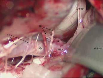 VA anevrizma domları genellikle dorsal veya süperiora dönük oldukları için klip uygulaması için doğrudan görülebilirler. Bu durumda VA e paralel bir düz klip uygulanabilir.