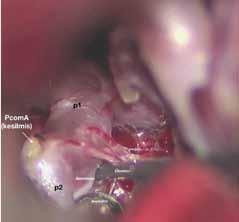 gelmektedir. Baziler apeks anevrizması cerrahisinde talamoperforan dalların görülmesi ve korunması esastır.