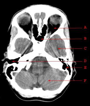 Anatomi.. A. Orbita B. Sfenoid Sinus C. Temporal Lob D.