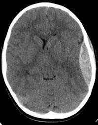 (%85) orta meningeal arterin