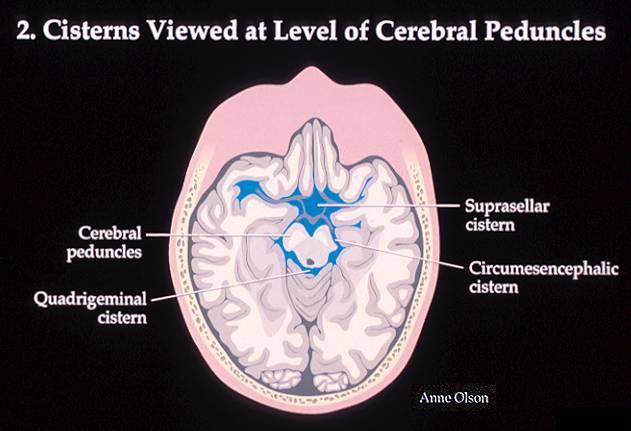 Can = Cisterns: (Blood Can Be Very Bad) Siircummesencephalic (ambian) orta beyinde halka şeklinde Suprasellar
