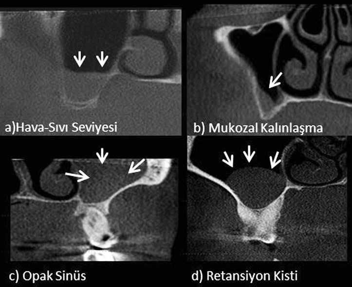 31 68,2 15 25 15 0,019* p-değeri 0,000* 0,000* 0,033* 0,000* Tip 1 Tip 2 Tip 3 Tip 4 % n % n % n % n p-değeri Antral Patoloji (+) 39,7 23 24,1 14 10,3 6 25,9 15 0,000* Antral Patoloji (-) 56,2 136