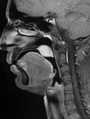 249 Şekil 1. Tümörün MRI görüntüsü. Şekil 2. Tümördeki tübül benzeri yapılar (H&E, x200). Şekil 3. Tümör stromasındaki bazal membran benzeri hyalinize materyal, (H&E, x200). Şekil 4.