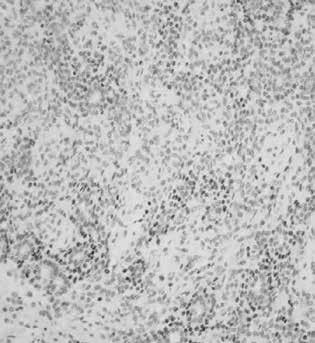 Histolojik olarak tümör lobuler büyüme paterni gösteren, duktus benzeri yapılar ve solid alanlar yapmış tümör hücrelerinden oluşur.