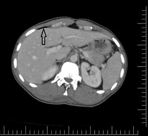 256 Figure 1. Transverse scan of CT showing (arrow shows the free air anterior of the liver). Figure 3. CT scan of vertebra (arrow shows the burst fracture of 12th spine).