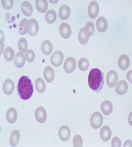 MF ve SS da Evreleme ve Sınıflama: Periferik Kan B: Blood B 0 B 1 B 2 MFCG Staging/ Classification of CTCL, 1979 [1] Dolaşımda atipik hücre yok (< 5%) Dolaşımda atipik hücre var ( 5%) ISCL/EORTC