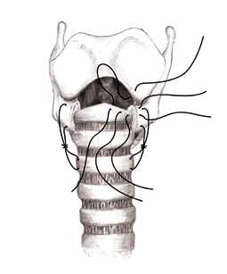 238 den bağlanır ve kesilir. Bunu takiben, posterior mukoza anastomoz dikişleri teker teker lümen içinde anteriordan düğümleri mukozanın arkasına gömülecek şekilde bağlanır ve kısa olarak kesilir.