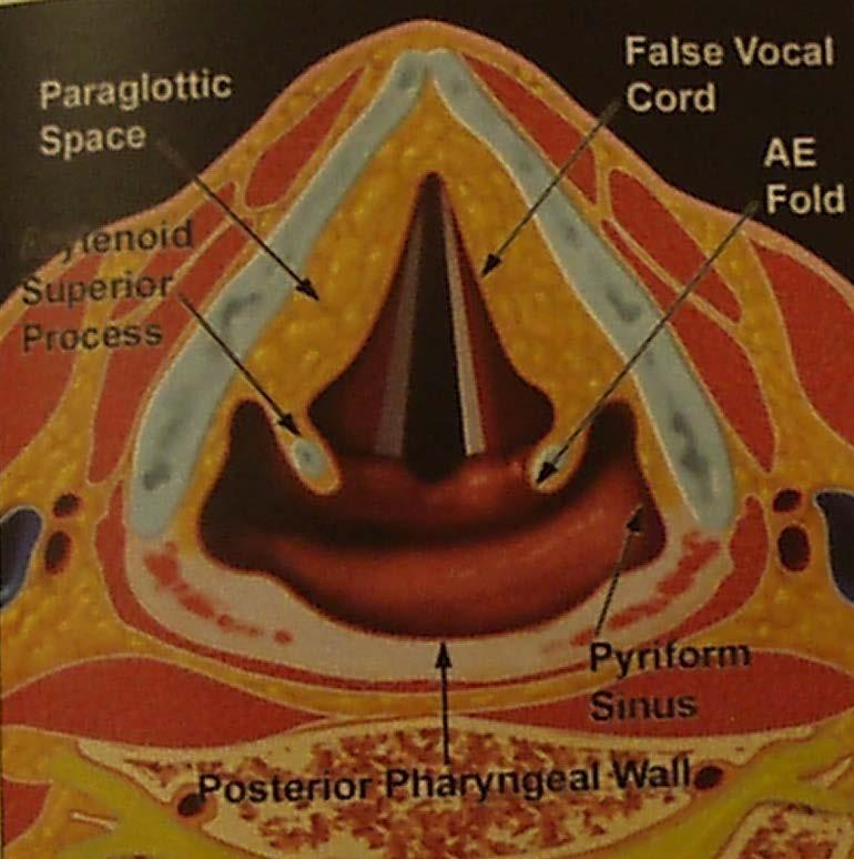 Priform sinüs