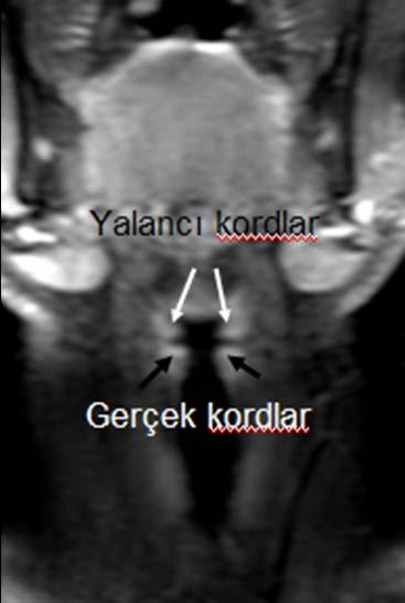 Ventriküler appendiks 1 cm Resim: