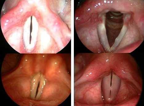 2.4.4. KĐSTLER Şekil 22. Kistler Larenks kistlerinin sınıflandırılmasında tam bir görüş birliği olmamakla birlikte, şu şekilde tanımlanabilirler (22): 1.