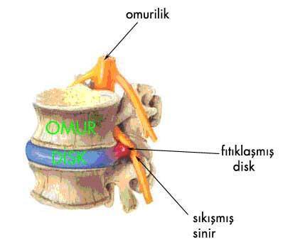 Spondylitis (spondilit): Omur veya omurların iltihabı.