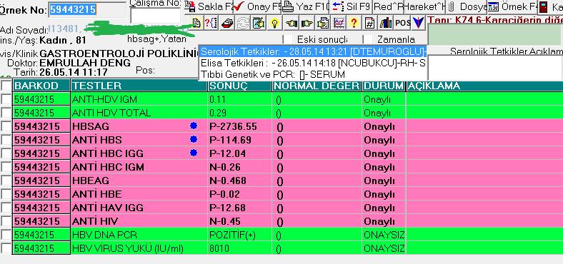 HBsAg ve antihbs pozitif hastalarda HBV DNA analiz edilebilir seviyelerde