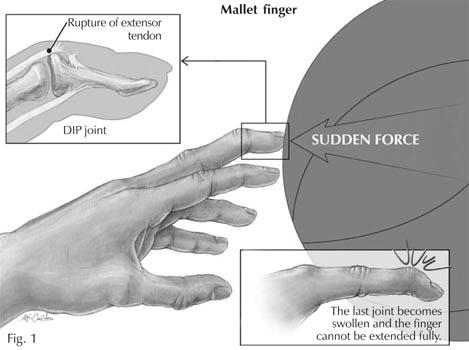 proximalindeki ekstansor tendon yaralanmaları tecrübeli acil uzmanları tarafından onarılabilir El