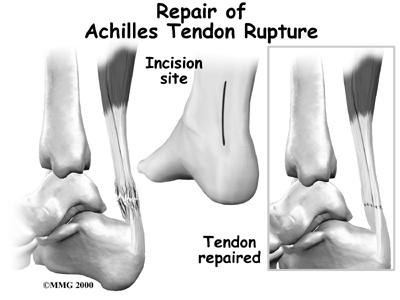 AYAK VE AYAKBİLEK KESİLERİ Özellikle tendon kesileri açısından dikkat edilmeli Ekstansor hallucis longus Tibialis anterior Achille Achille tendon rüptürü thompson testi ile değerlendirilir Tendon