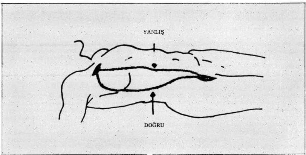 Ekstra Anatomik By-Pass'lar ve Sonuçlan /TAŞDEMİR, KOÇAK, ZORLUTUNA, YAŞAR, YAKUT, BAVAZIT Şekil-1.