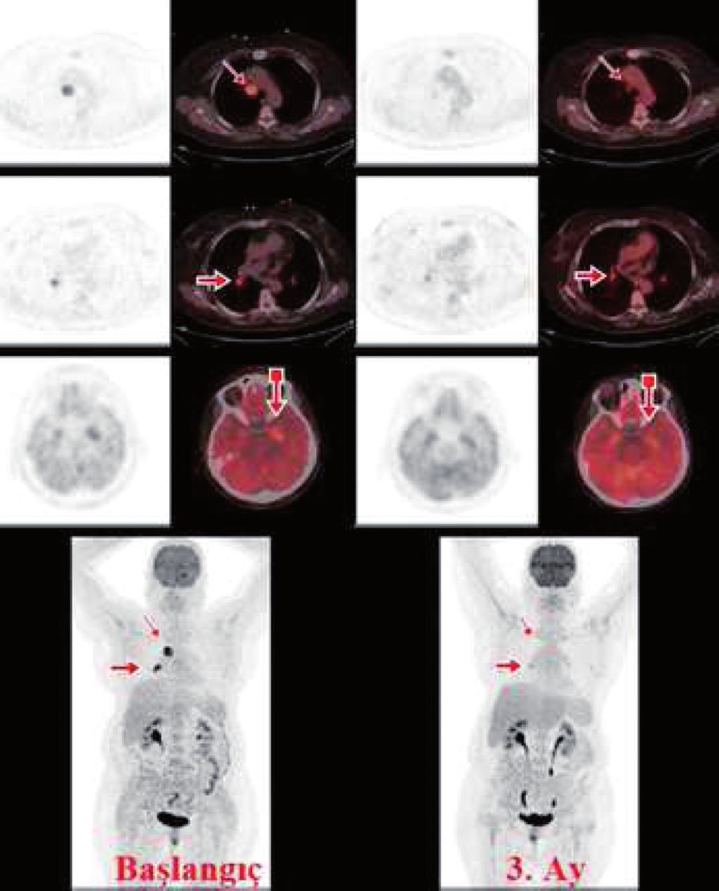 RESiM 2: Sağ hiler santral yerleşimli primer tümöral lezyon (kalın ok) ile sağ alt paratrakeal alanda yerleşimli